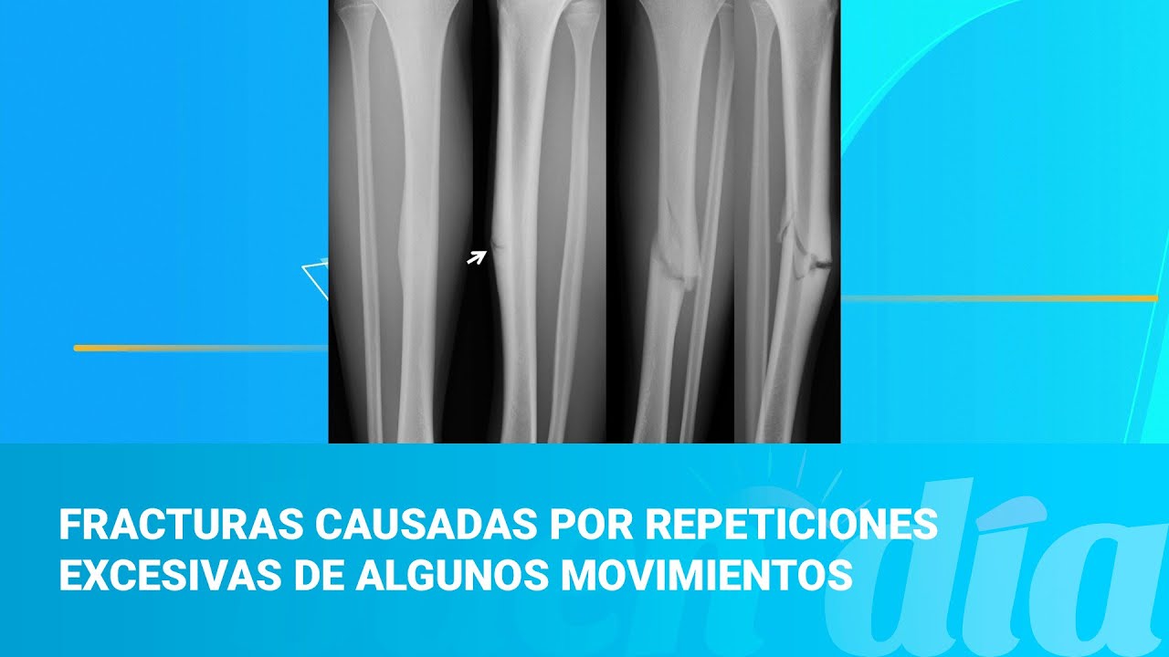 Fracturas causadas por repeticiones excesivas de algunos movimientos