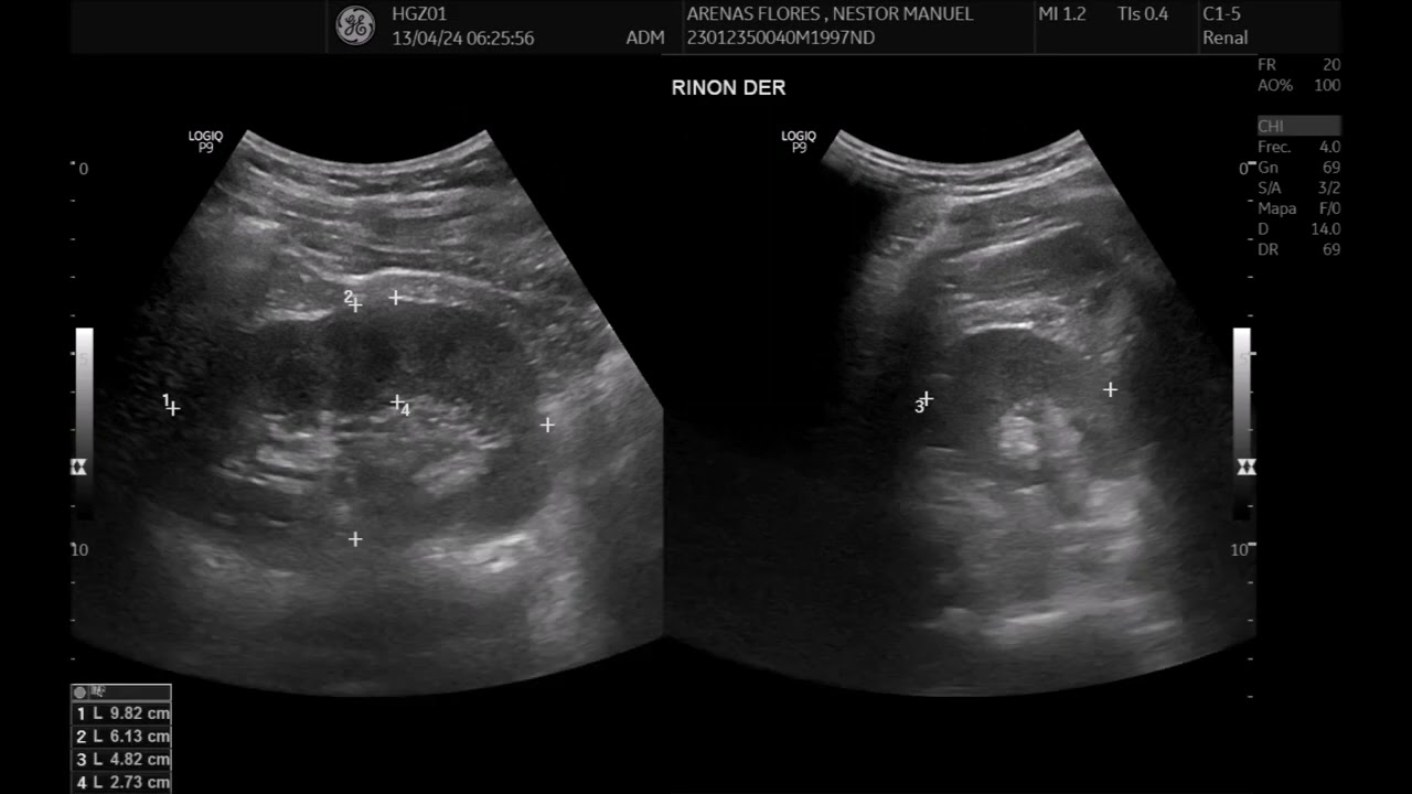 Como hacer un ultrasonido renal