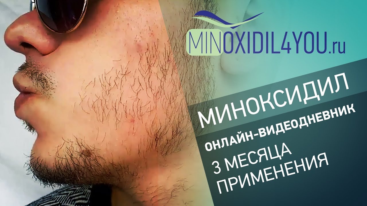 Миноксидил для бороды. Онлайн-видеодневник. 3 месяца применения. Minoxidil4you