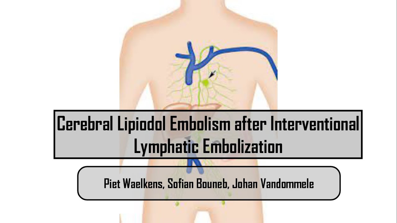 Cerebral Lipiodol Embolism after Interventional Lymphatic Embolization