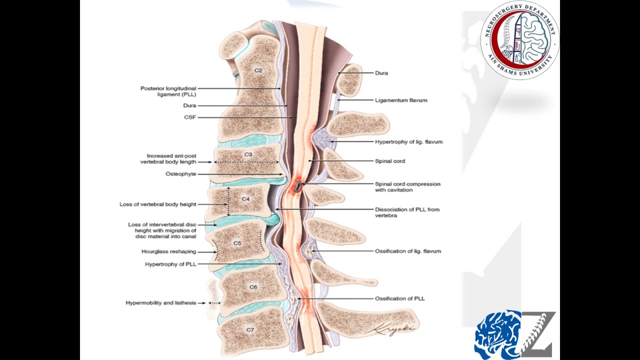 Degenerative Spine (20) : Cervical Spondylosis (1)  خشونة الفقرات العنقية
