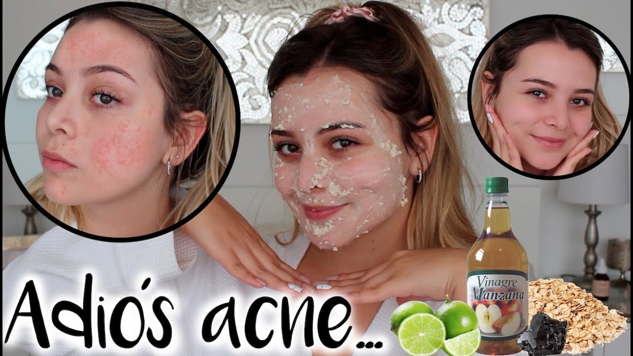 Rutina para eliminar el acné y sus cicatrices! Remedios Naturales - Maqui015 ♥
