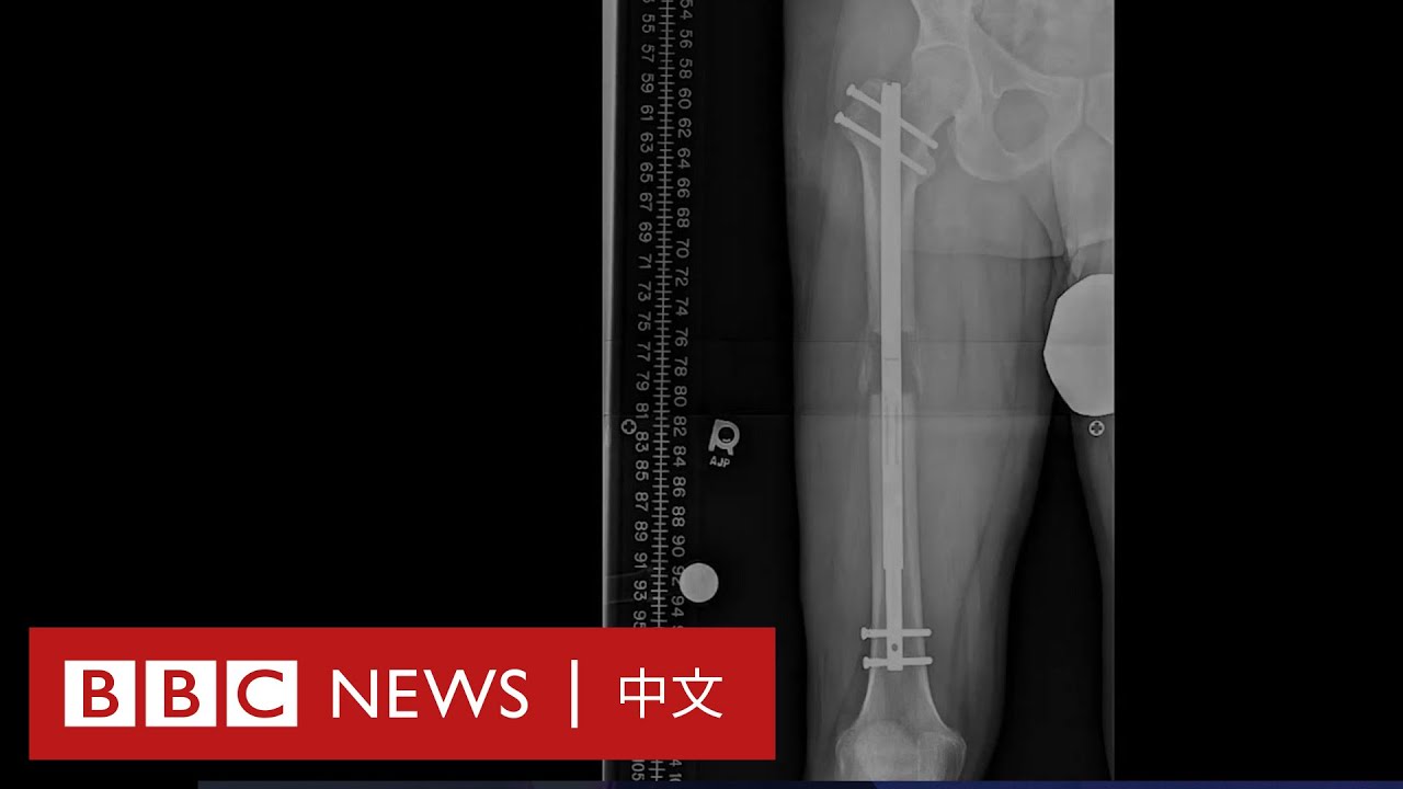 植釘子入腿骨的增高手術揭秘 163厘米男長高了多少？－ BBC News 中文