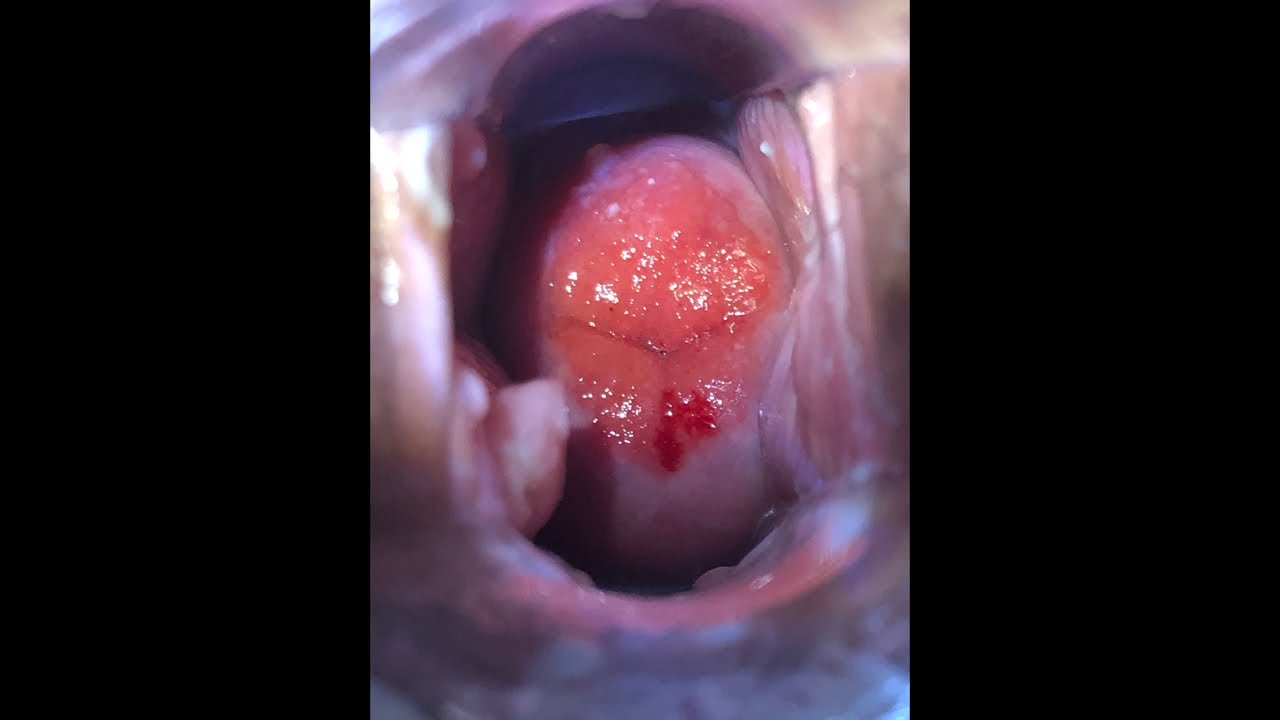 Endometriose profunda  - Live especial