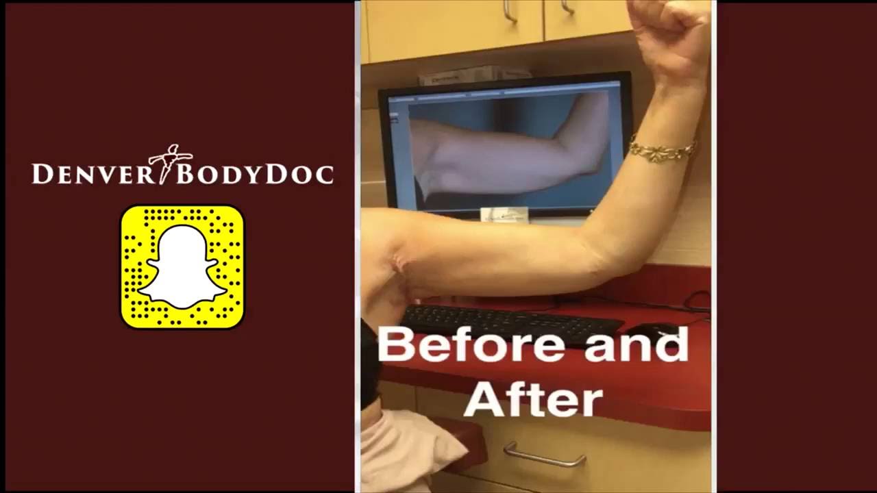 Axillary Arm Lift Post Surgery Appointment