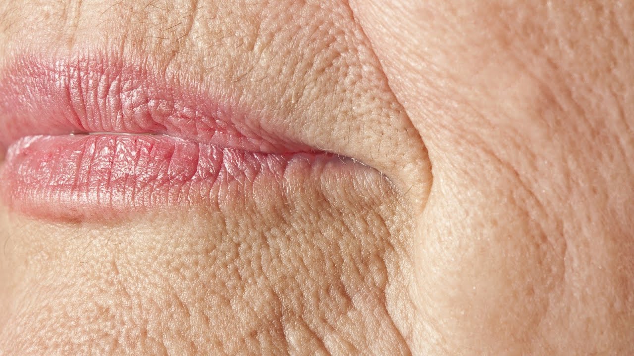 Treating Skin Folds