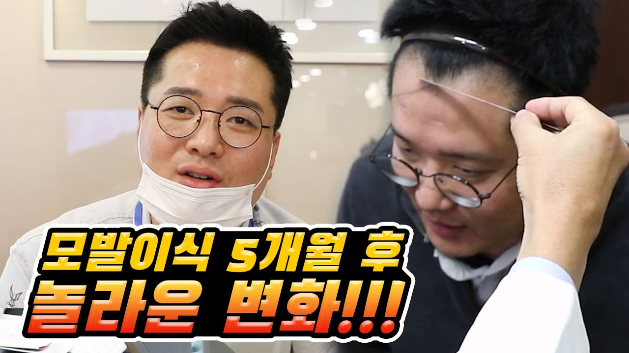 비절개 모발이식 5개월차(150일차) 모심기 인터뷰 Vlog 2탄 I 정말 머리가 많이 자랐습니다🤣 M자 탈모ㅣ모발이식 비용이 얼마?! 궁금하면 드루와~[쀼]