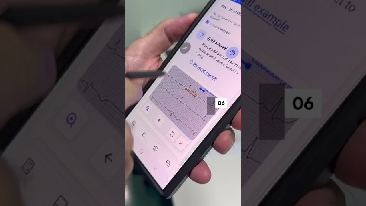 Learn how to measure the corrected QT interval (QTc) using Kraemer Academy&rsquo;s qtc.mocha.app app.