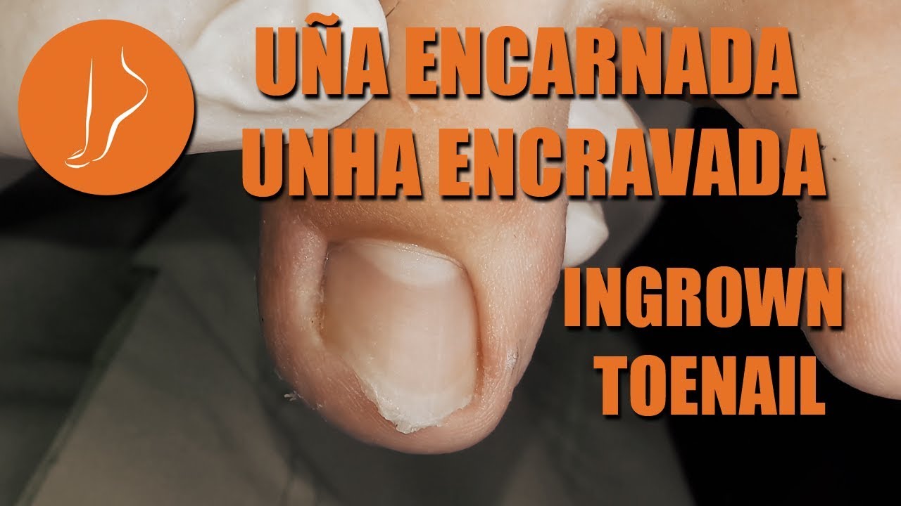 U&ntilde;a encarnada - Unha encravada - Ingrown toenail [Podolog&iacute;a Integral]