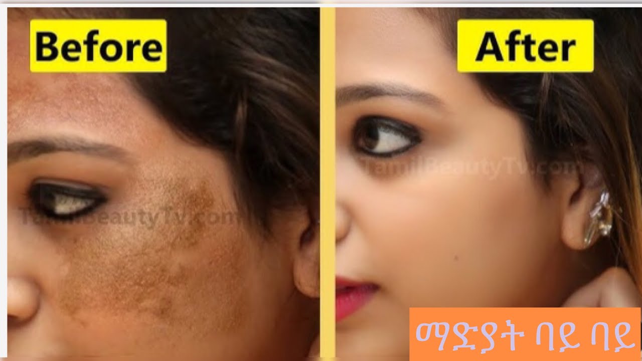 ማድያት ባይ ባይ Remove Wrinkles,Get Instant Face Lift naturally,Mouth Wrinkles.