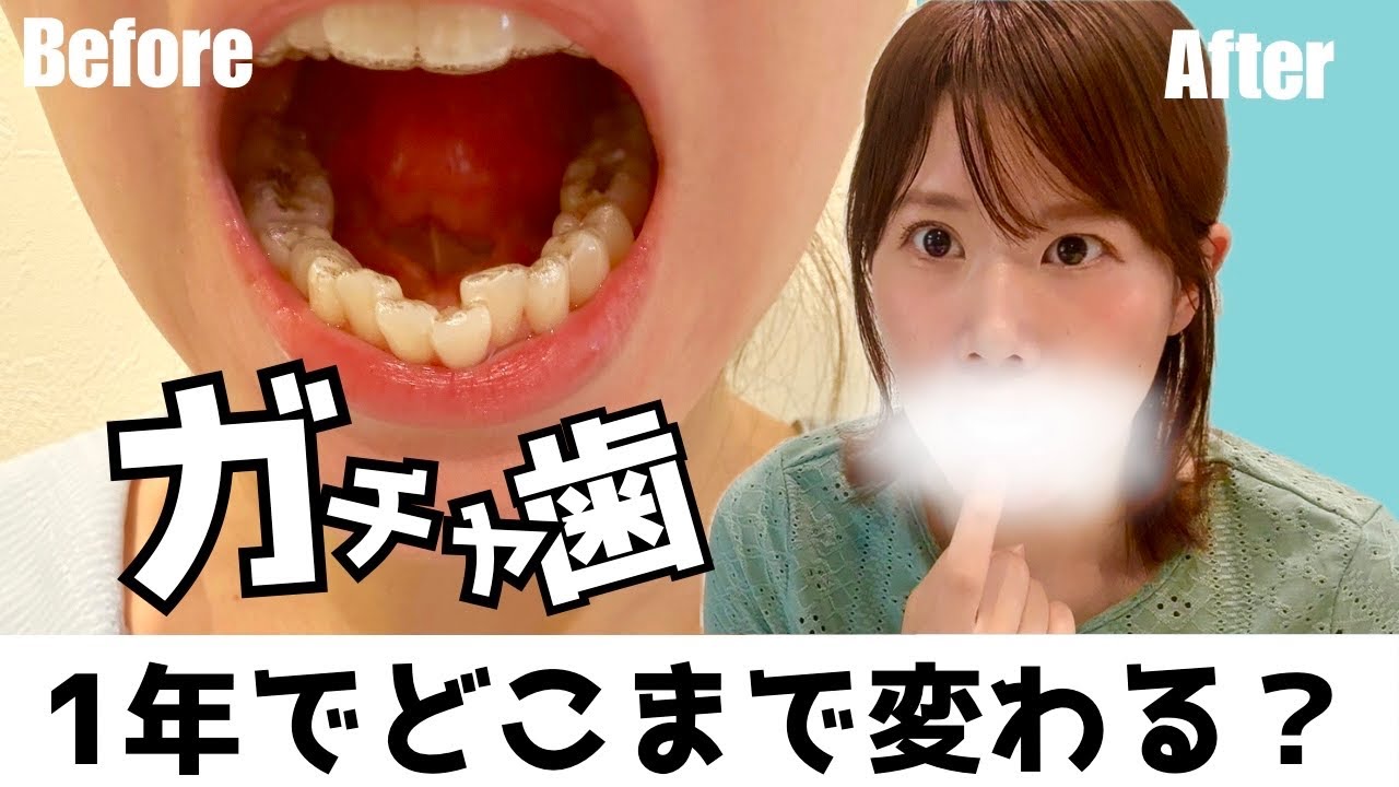 【歯列矯正】老け顔に見えるガチャ歯...解消したくてインビザライン始めました！１年たった経過報告
