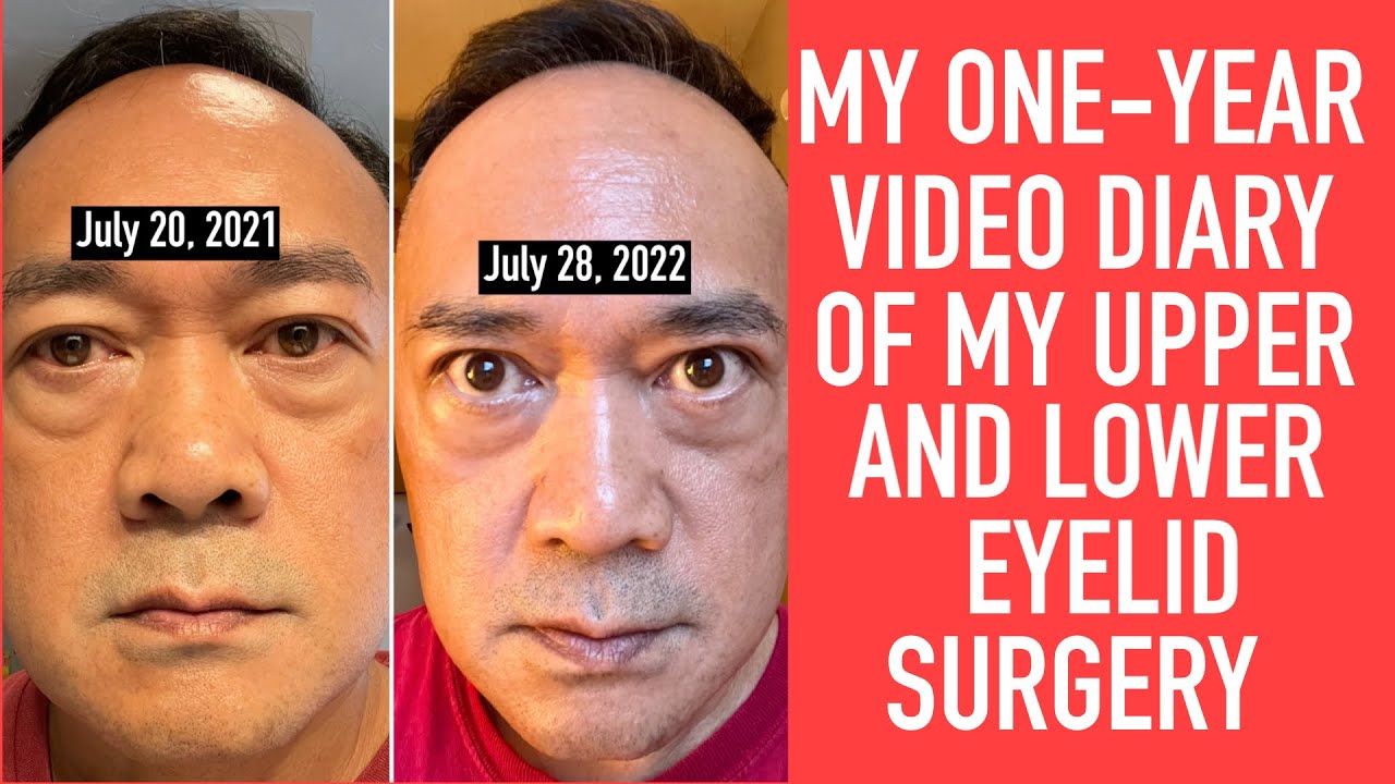 My One-Year Video Diary of My Upper and Lower Eyelid Surgery