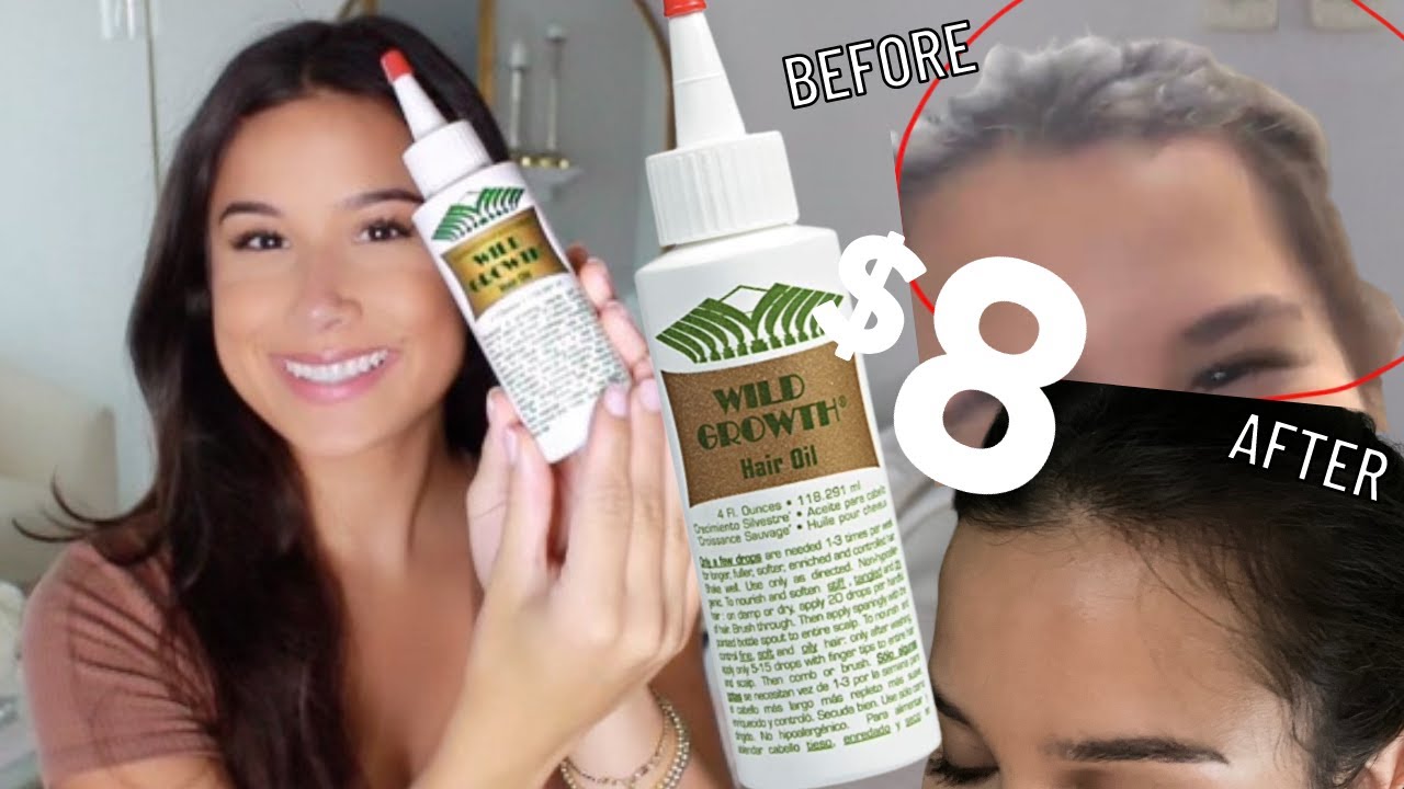 HOW I GREW MY HAIRLINE BACK WITH AN 8 DOLLAR PRODUCT | Wild Growth Hair Oil Review