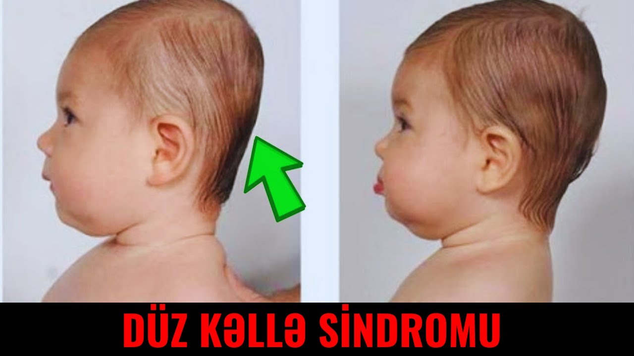 Uşağın başının arxasının düz olmasının səbəbi nədir? - Düz kəllə sindromu