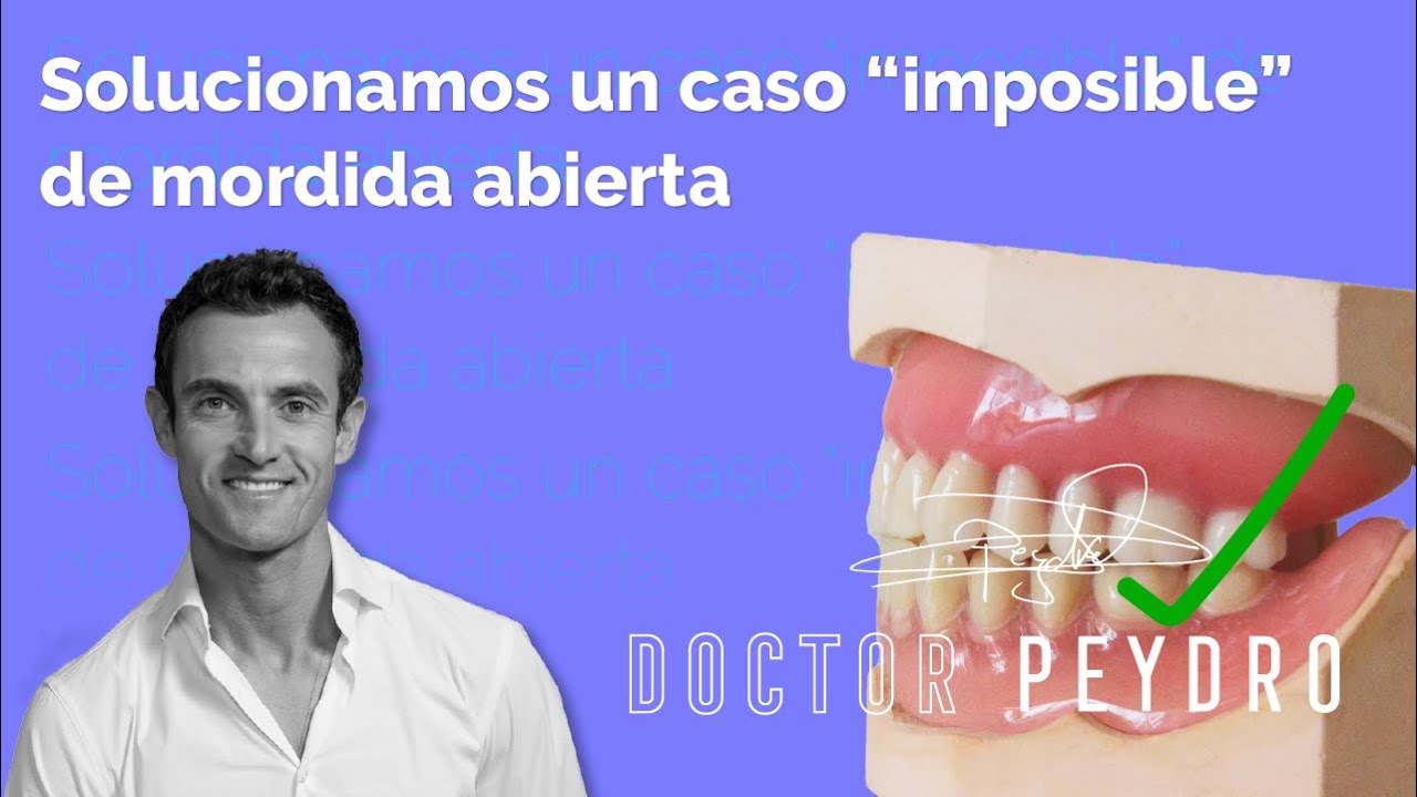 MORDIDA ABIERTA. Cómo corregirla con ORTODONCIA INVISIBLE