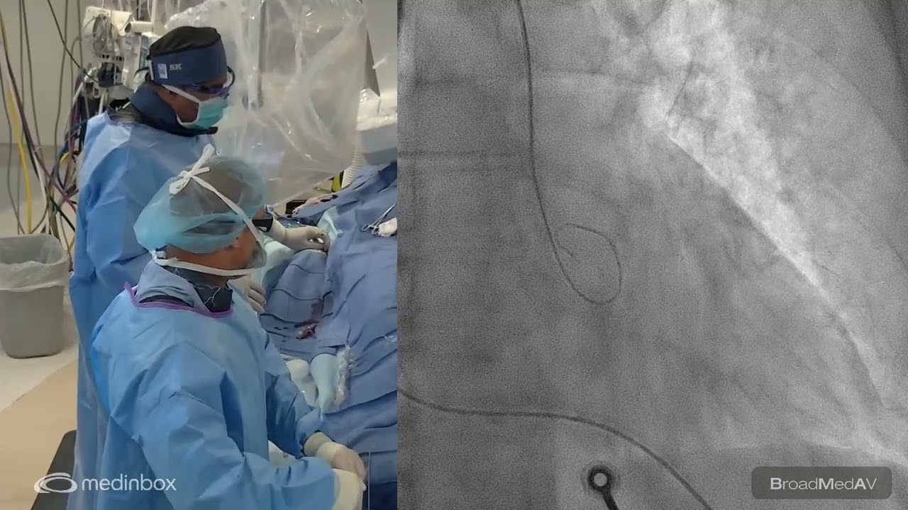 Alcohol Septal Ablation To A Patient With HOCM And MR