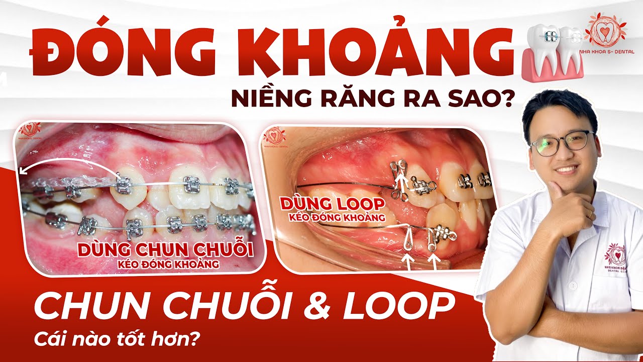 Hé Lộ Cơ Chế Kéo Đóng Khoảng Niềng Răng: Chun Chuỗi Hay Loop Kéo Khoảng Tốt Hơn? | Nha Khoa SDental