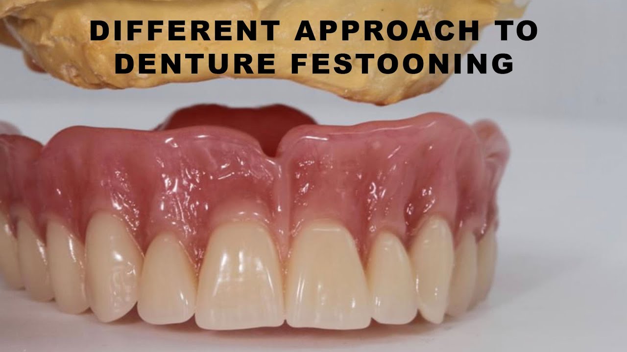 Different Approach to Denture Festooning