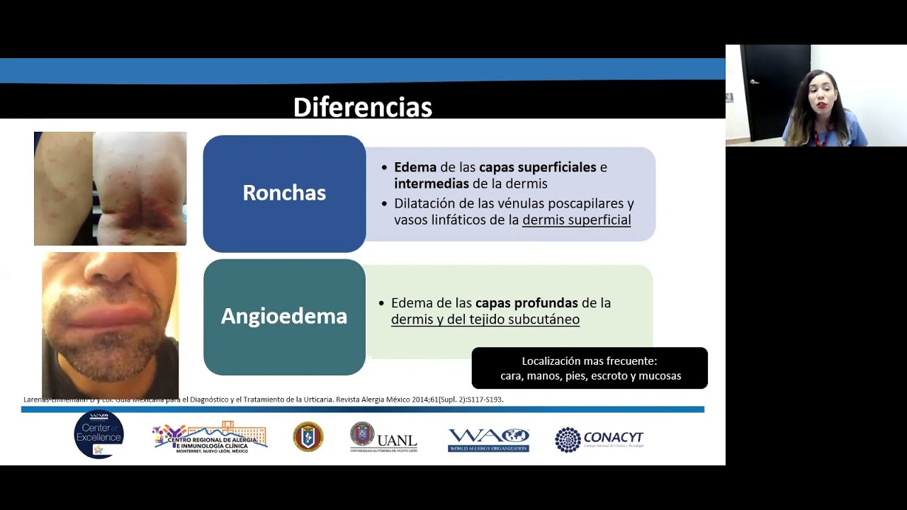 Urticaria y angioedema (Guía mexicana y EAACI).