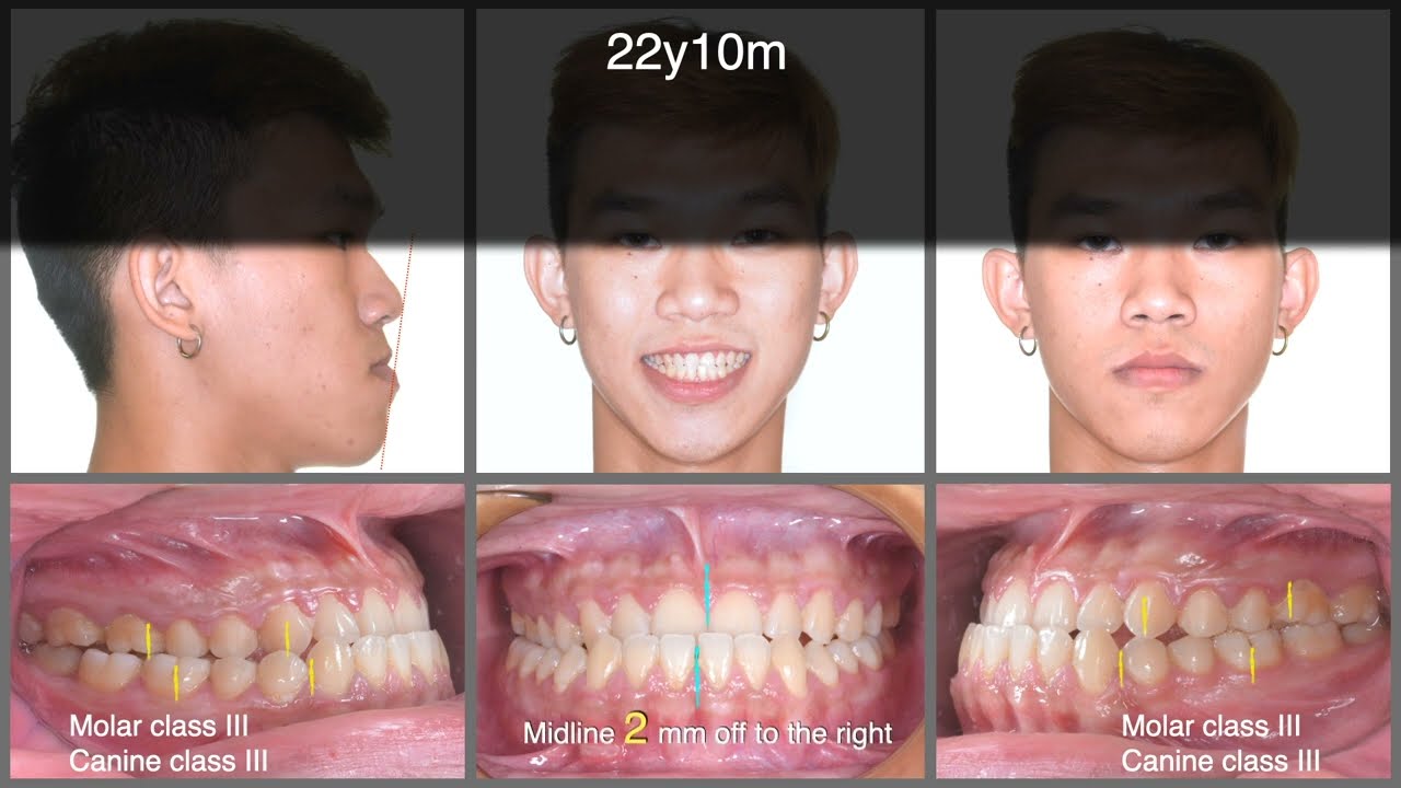 Treatment of CIII Malocclusion with Insignia｜【Chris Chang Ortho】CC642