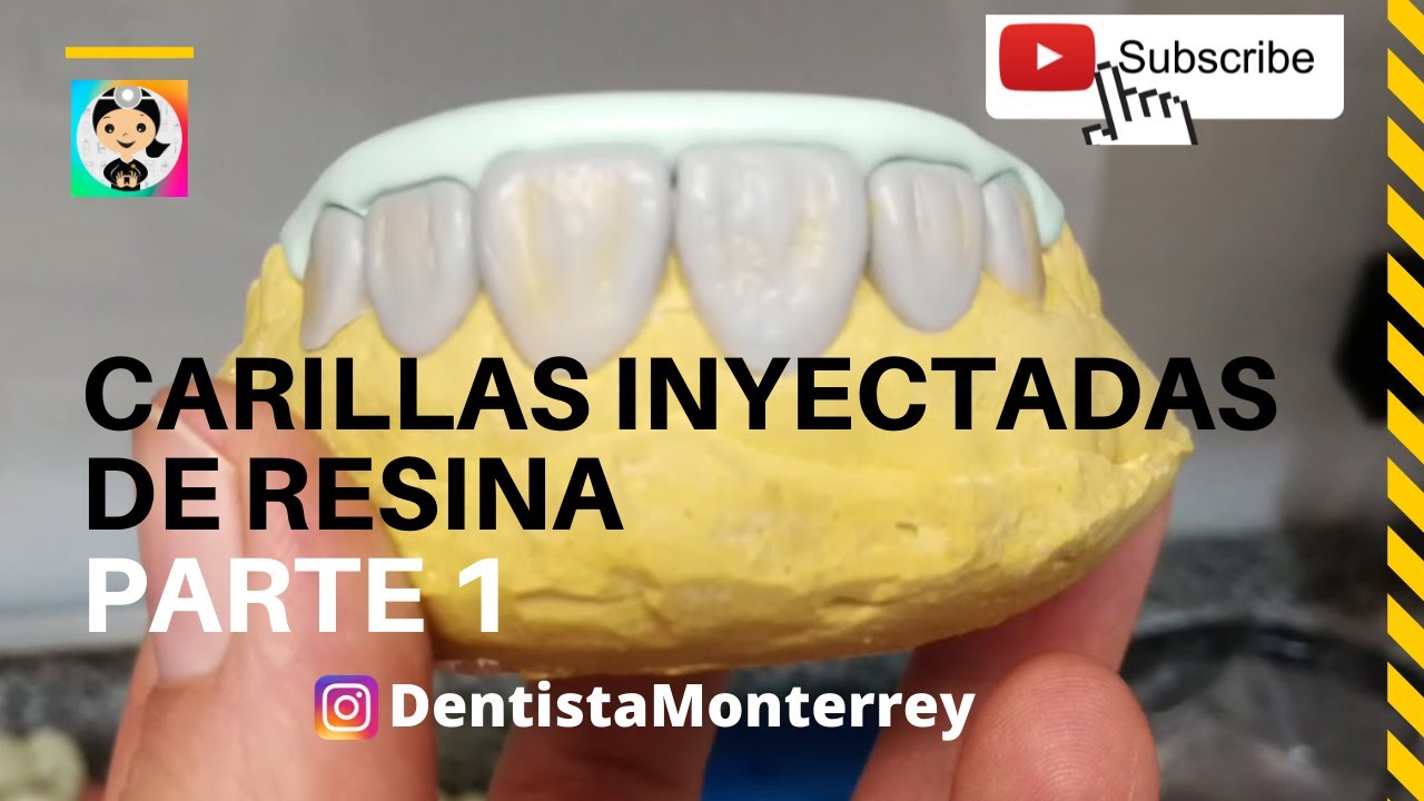 CARILLAS DIRECTAS PASO a PASO 👅Parte 1 Técnica de Inyección #carillasderesina