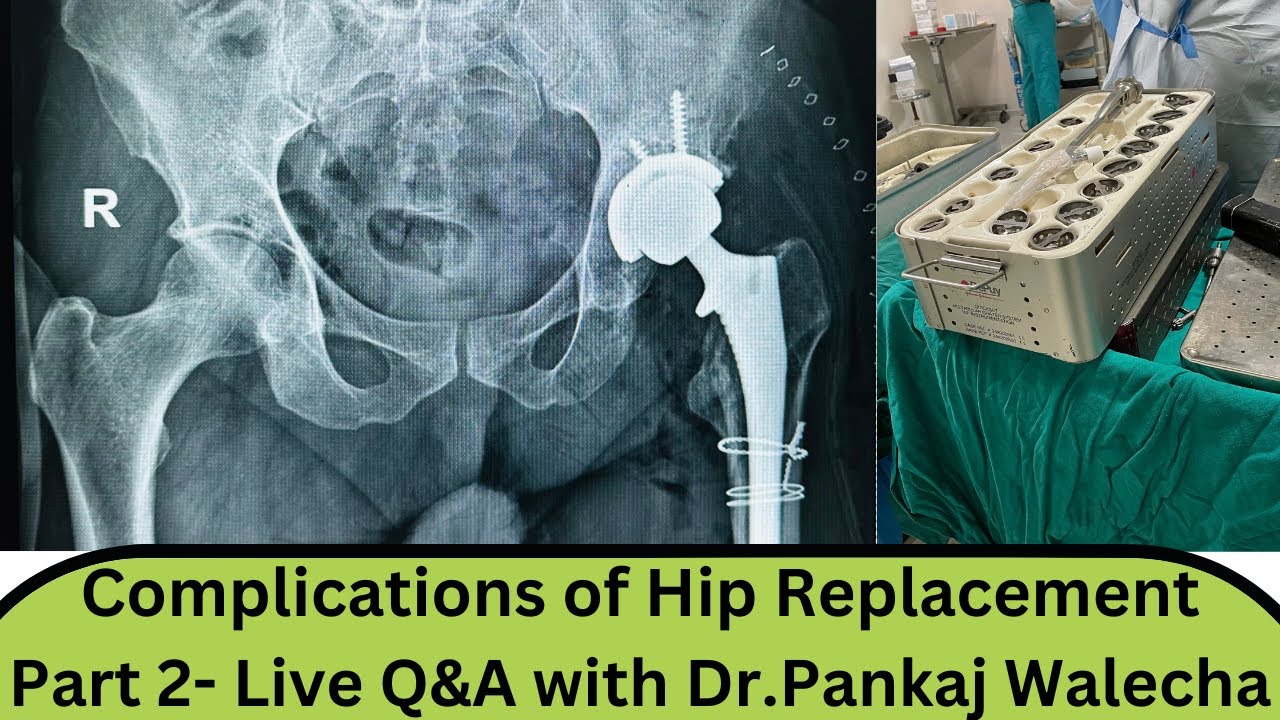 Complications of Hip Replacement Part 2- With Dr Pankaj Walecha
