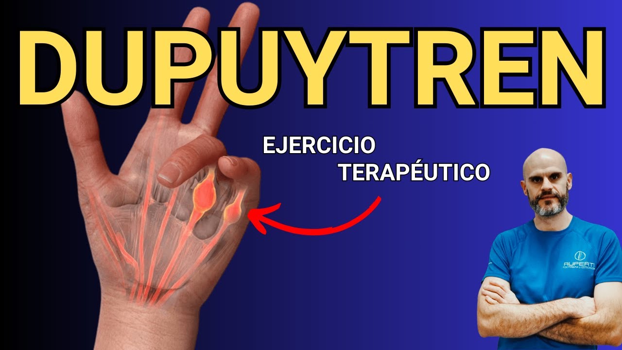Cómo Tratar la Enfermedad de Dupuytren: Ejercicios para Mejorar la Flexibilidad de los Dedos