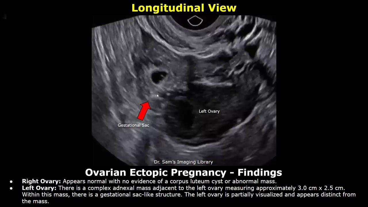 Отчет об УЗИ внематочной беременности | Трубное, интерстициальное, цервикальное, яичниковое и гет...