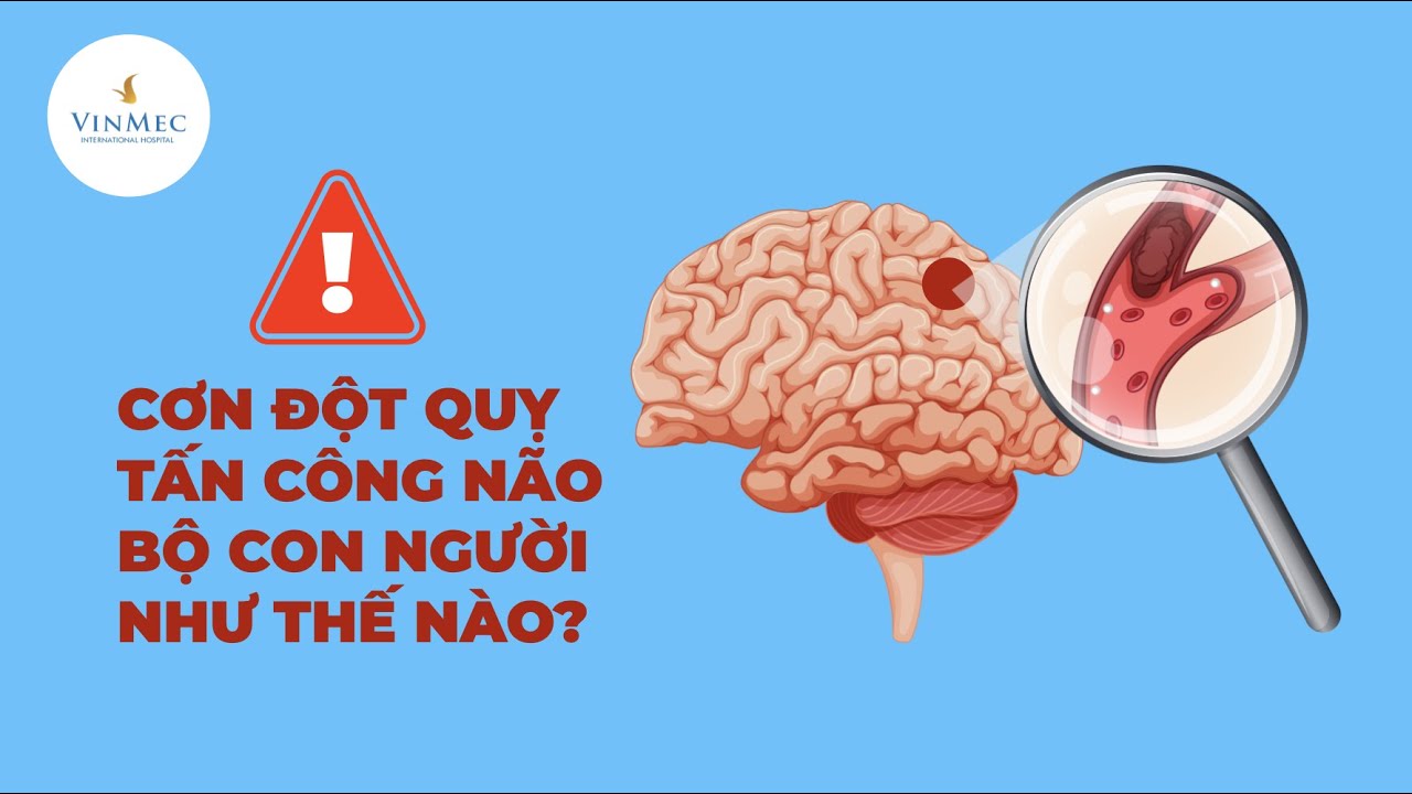 Cơn đột quỵ n&atilde;o tấn c&ocirc;ng bạn như thế n&agrave;o?| BS Nguyễn Thị Minh Phương, Bệnh viện ĐKQT Vinmec
