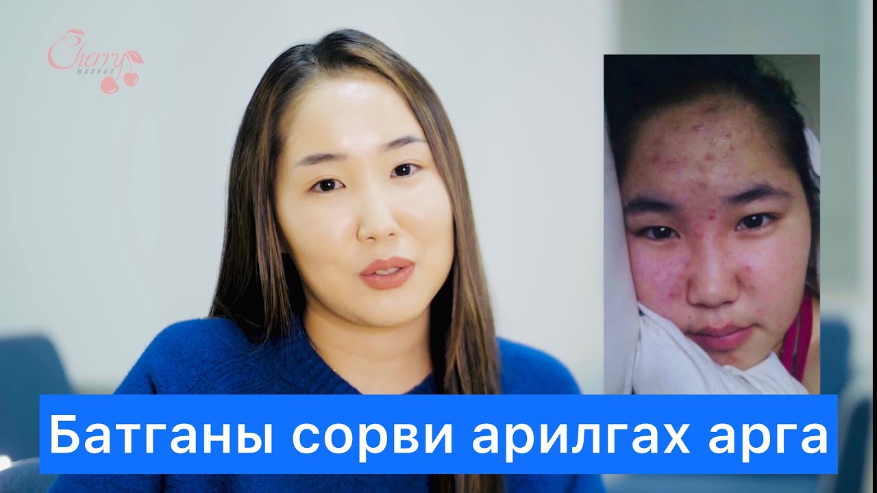 Батганы сорви арилгах арга
