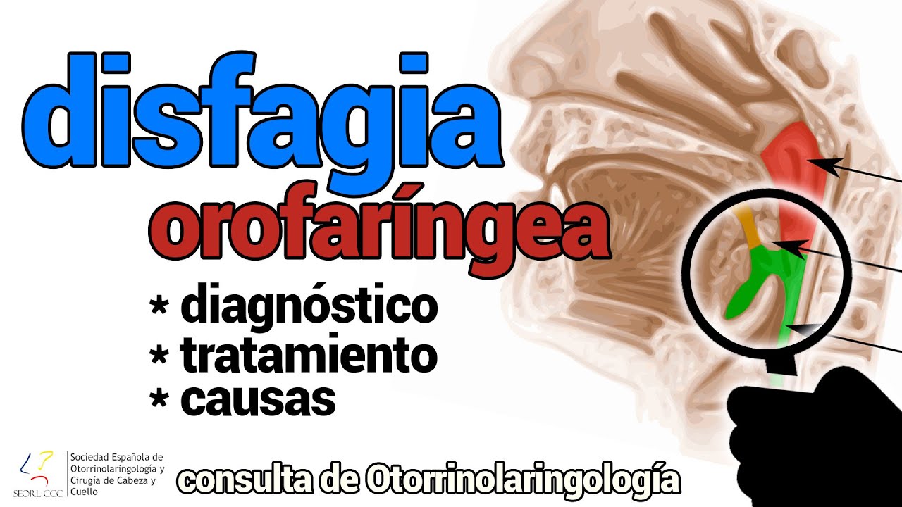 Disfagia orofaríngea | Trastorno de la deglución - SEORL CCC