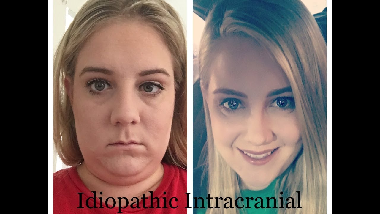 Idiopathic Intracranial Hypertension (IIH)