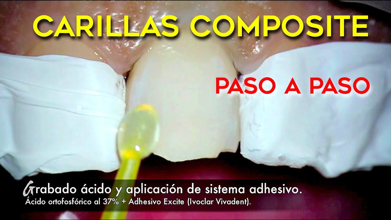 CASO REAL PASO A PASO DE CARILLAS DE COMPOSITE ESTÉTICAS EN DIENTES ANTERIORES LEVEMENTE FRACTURADOS