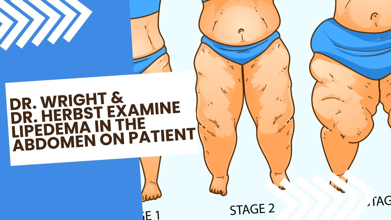 Dr. Wright & Dr. Herbst discuss Lipedema in the abdomen