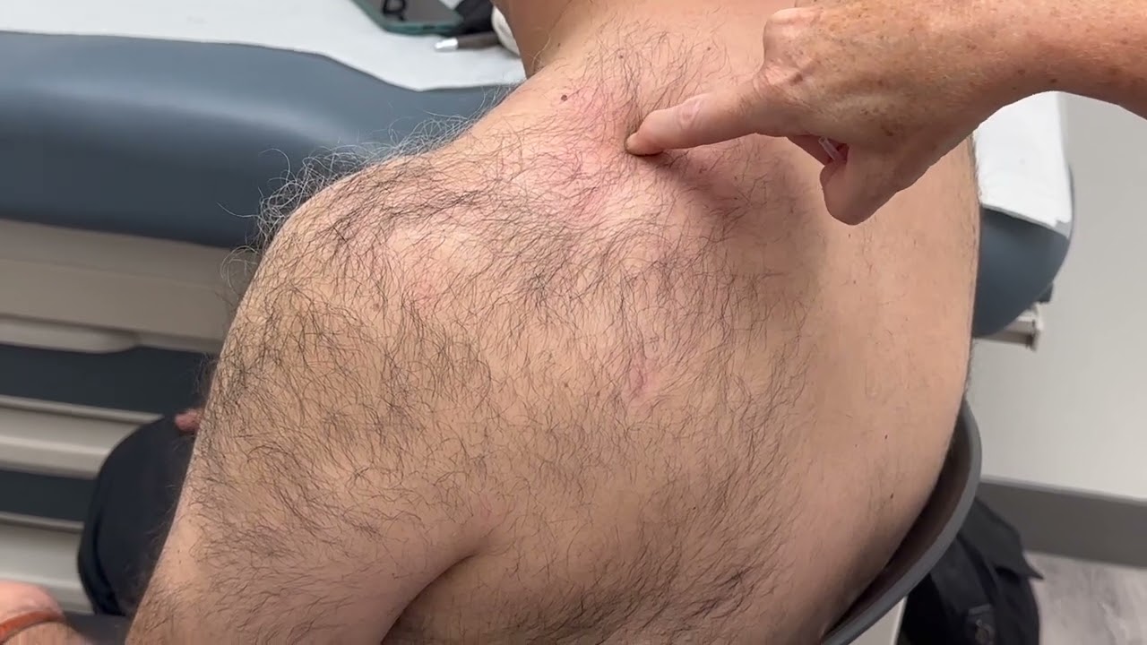 McMaster Medical Acupuncture Program: Tripple Warmer 15