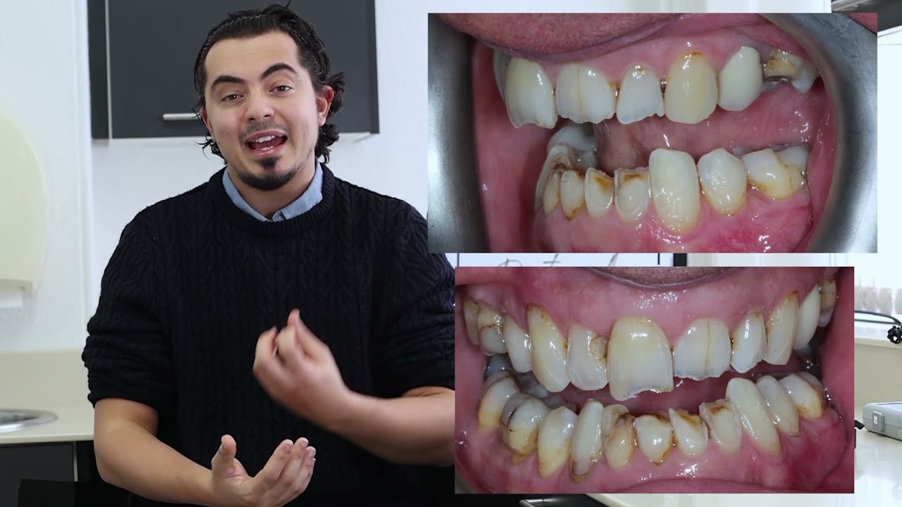 5 Minutes with Doctor A - Composite Bonding Case No. 1