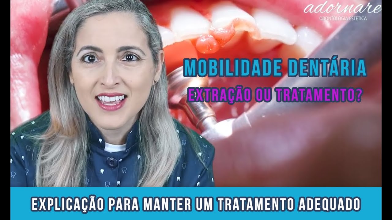 Dentes com Mobilidade: Quando Devo Extrair? Dra. Cíntia Amorim