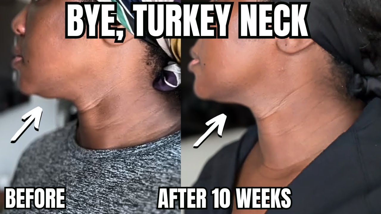 Red Light Therapy SNATCHED My Neck!