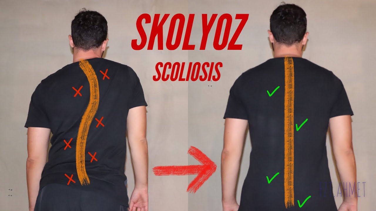 Skolyoz İçin 4 Egzersiz | 4 Scoliosis Exercises