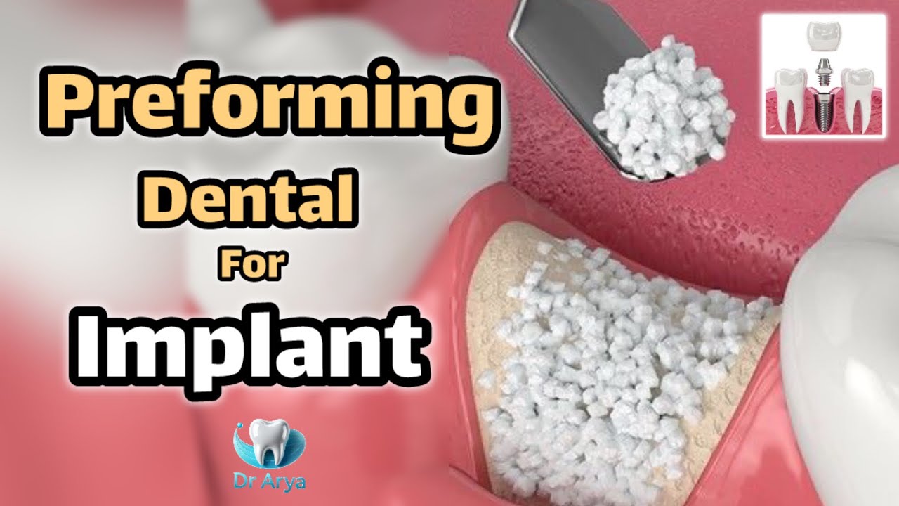 How to Perform Dental Implants (3D Dental Animation)