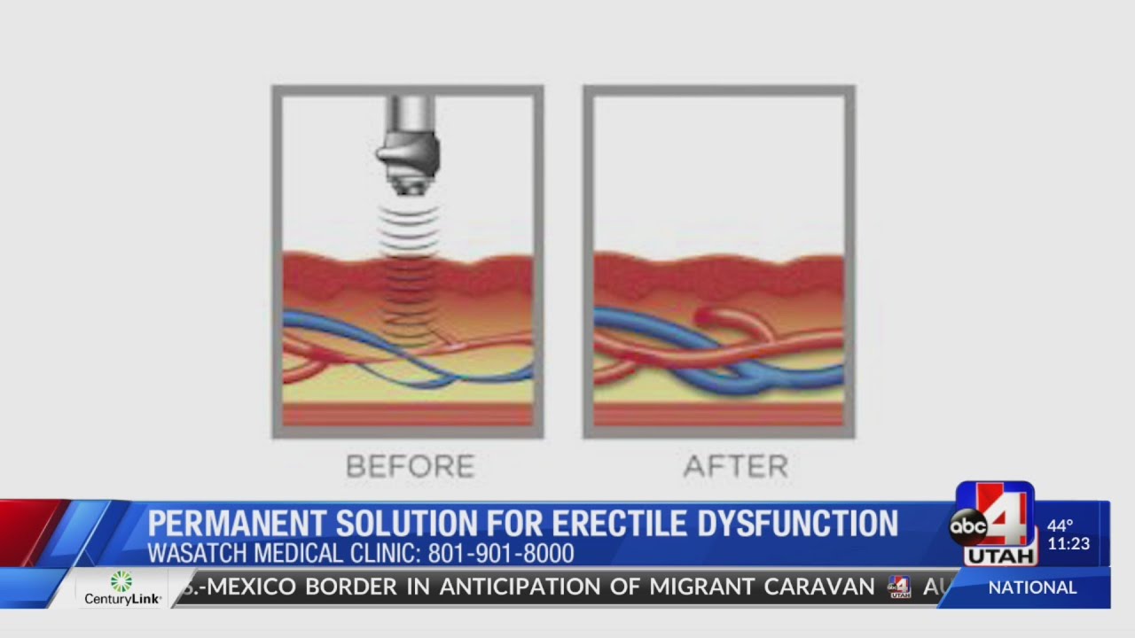 Permanent solution for erectile dysfunction