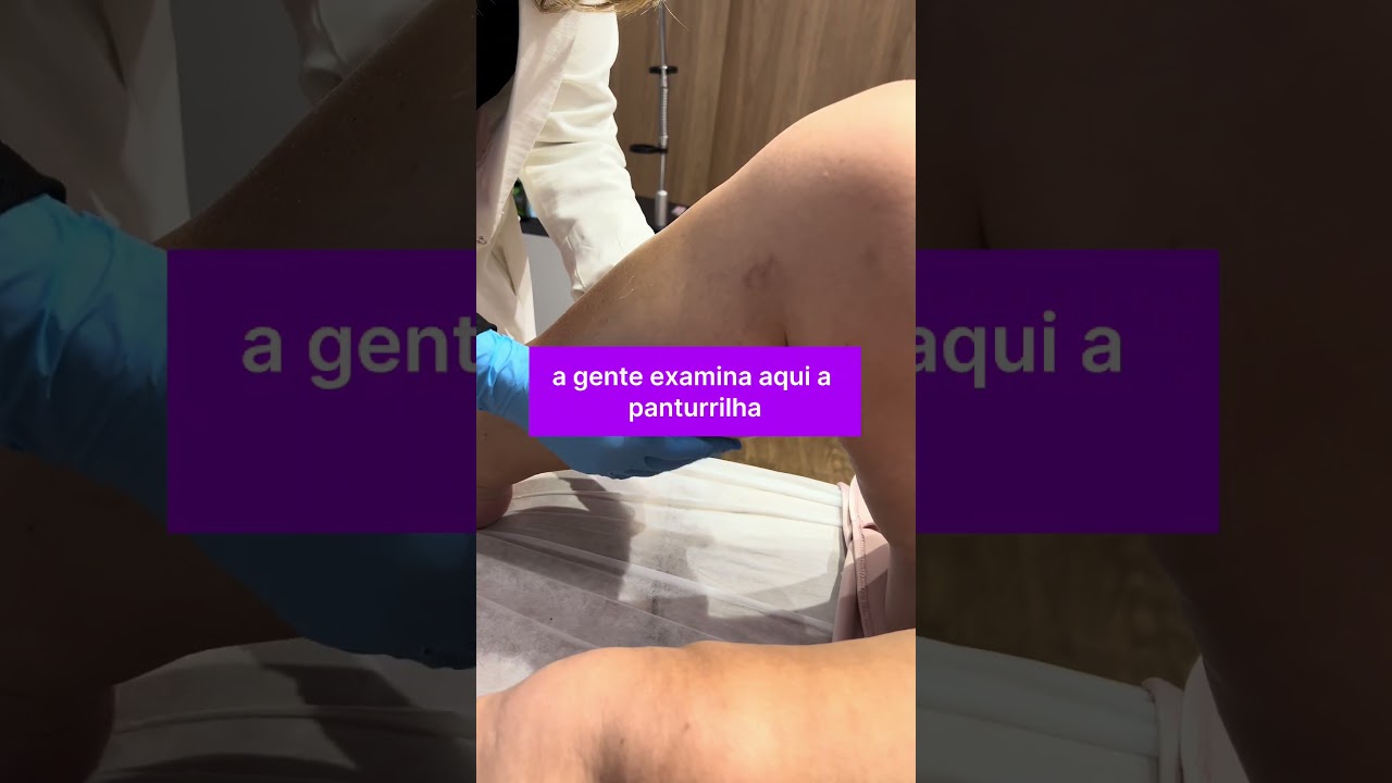 COMO RECONHECER UM SINAL DE TROMBOSE #tratamentovarizes #varizes #trombose