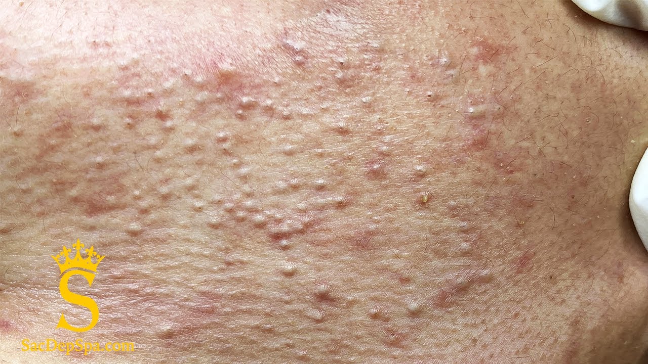 Pimples Around The Neck and Cheeks | Mụn Nổi Quanh Cổ V&agrave; M&aacute; - SacDepSpa#127