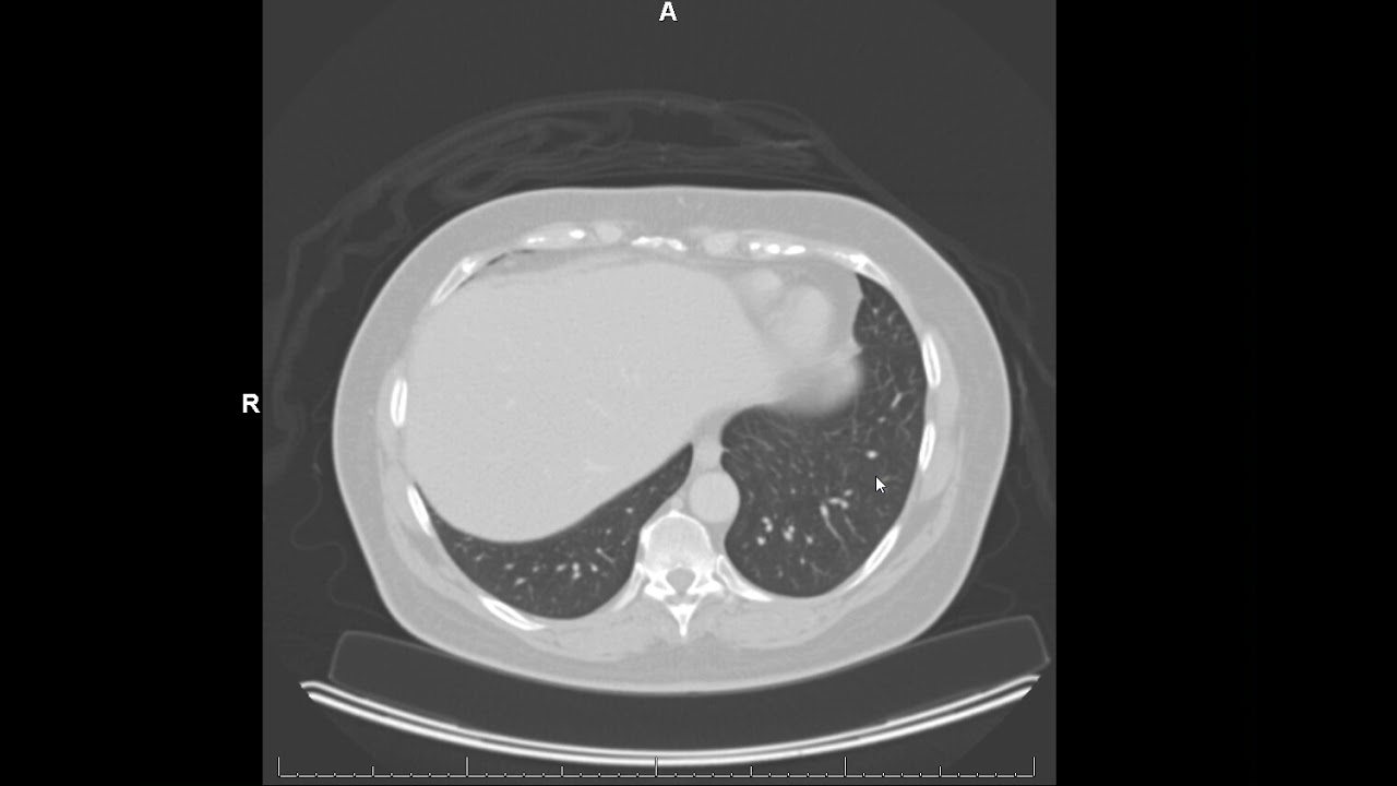 How CT scans work (Houndsfield units)