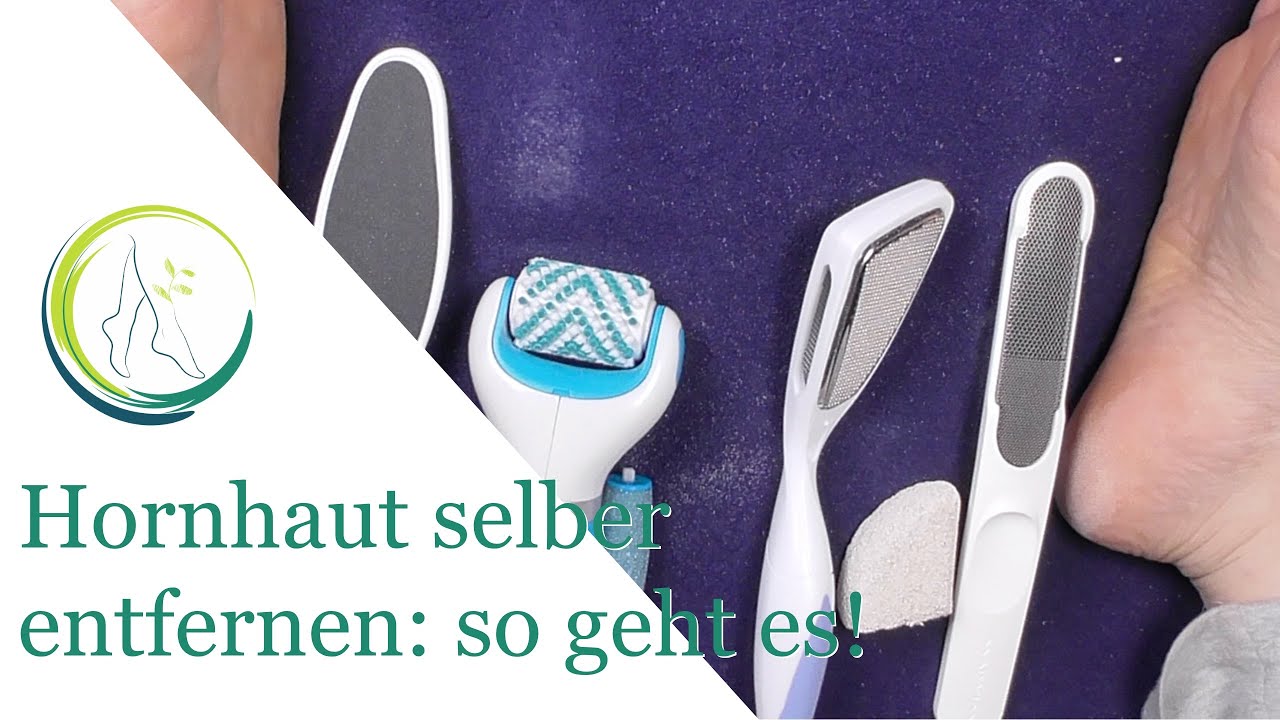 Удалите мозоли самостоятельно: вот как это работает! ортопед Андреа