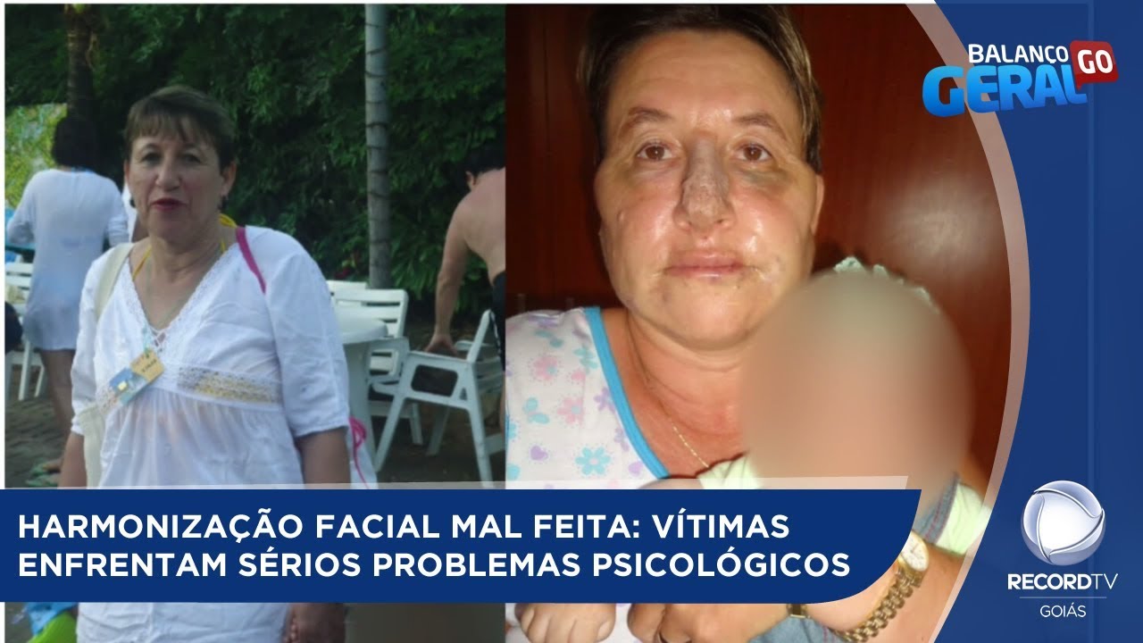HARMONIZAÇÃO FACIAL MAL FEITA: VÍTIMAS ENFRENTAM SÉRIOS PROBLEMAS PSICOLÓGICOS