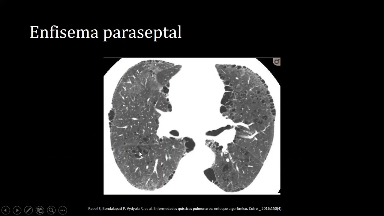 enfermedad pulmonar quistica
