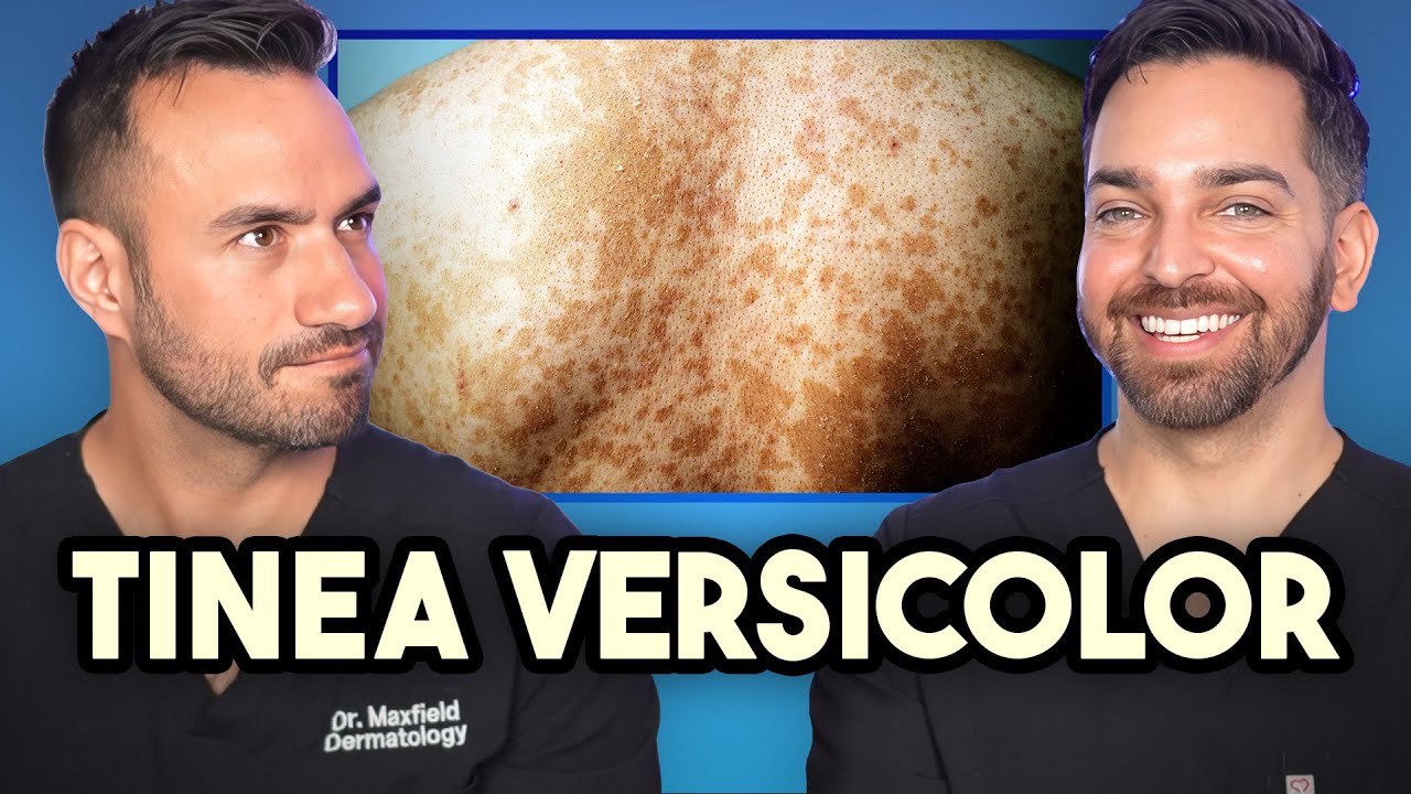 Patchy, Discolored Rash on the Body? How to Treat Tinea Versicolor like a Dermatologist