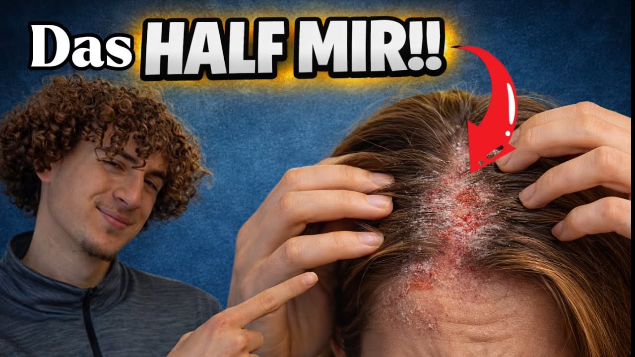 Diese 5 Routinen haben mir nach jahrelanger Schuppenpflechte geholfen - meine Erfahrungen