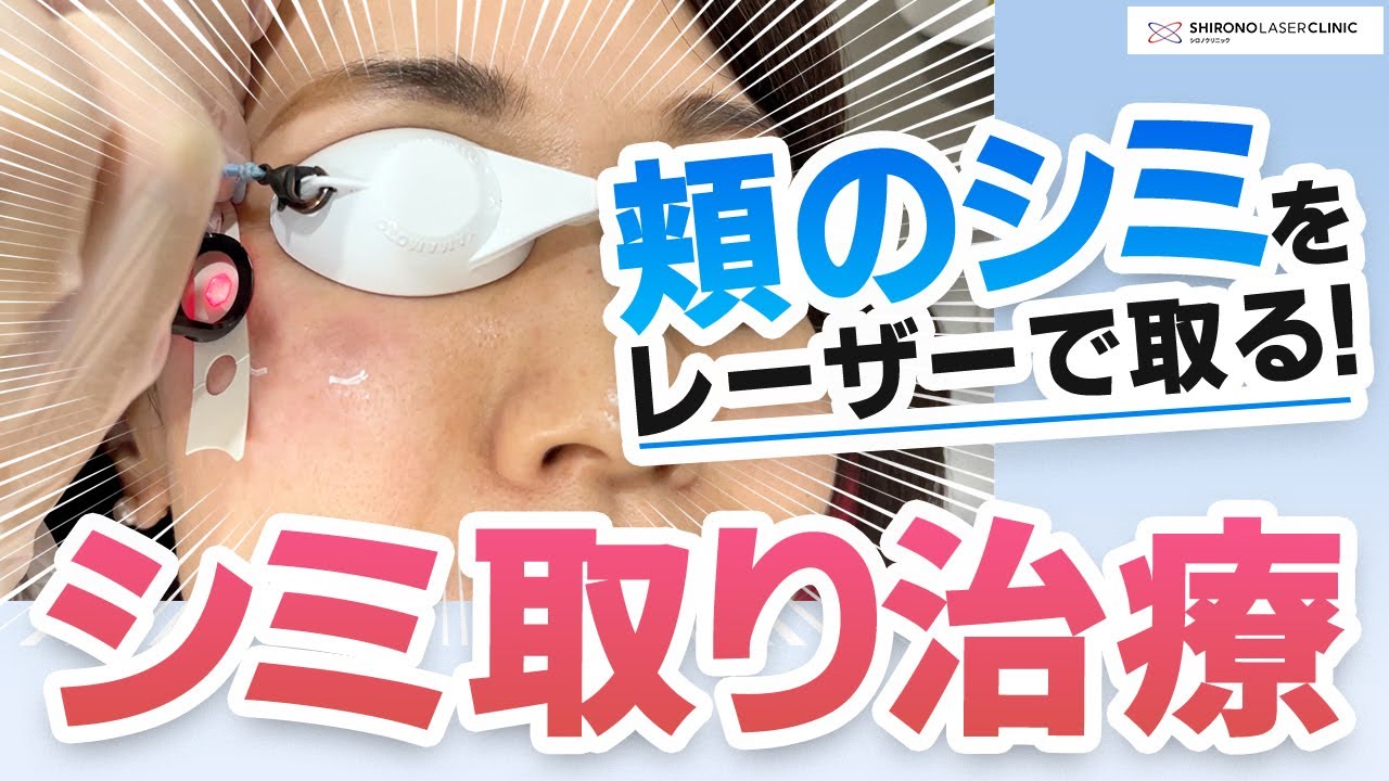 【レーザーで顔のシミを取る】治療からアフターケアまで解説